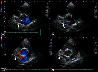 Case report: Echocardiographic and computed tomographic features of congenital bronchoesophageal artery hypertrophy and fistula in a dog